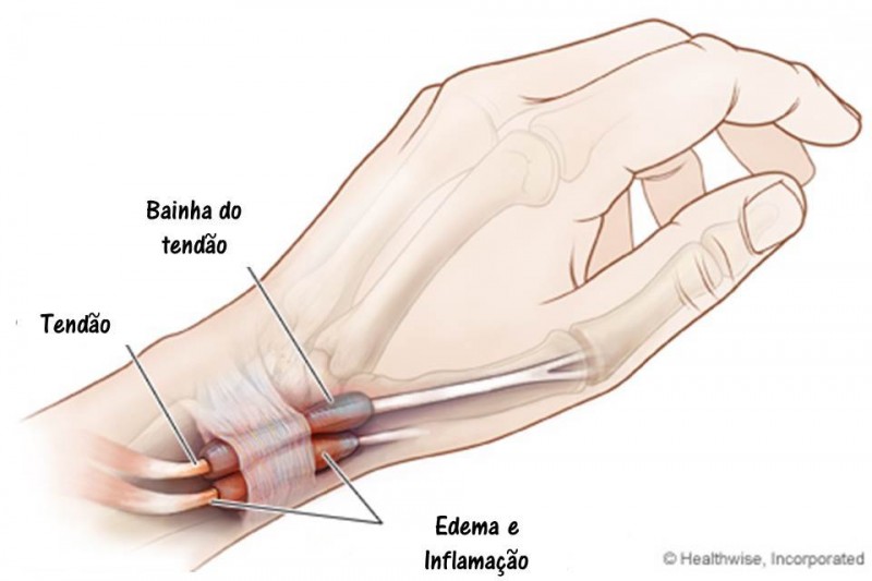 Blog Materno | Tendinite Pós - Parto Capa