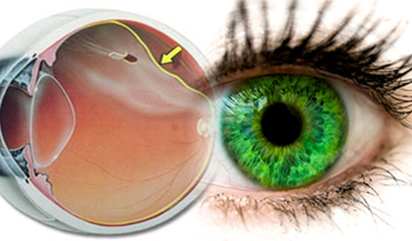 Saúde Ocular | Rompimento De Retina Eu Tive
